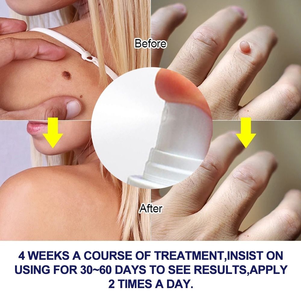 Wart removing spray Wart flat Nursing solution Chicken eye diced meat Fat granules Nursing repair fluid