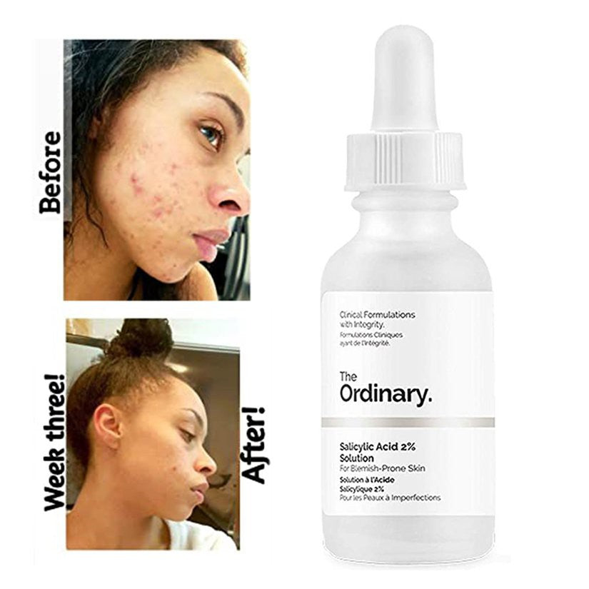 The Ordinary Salicylic Acid 2% Solution Clears Acne, Exfoliates, Reduces Blackheads, Improves Texture, Unclogs Pores, Minimizes Whiteheads, And Reduces Inflammation