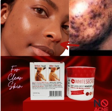 White Secret Dark/Black Spot/Acne Scars Remover/Dark Knuckle,Knees&Elbows