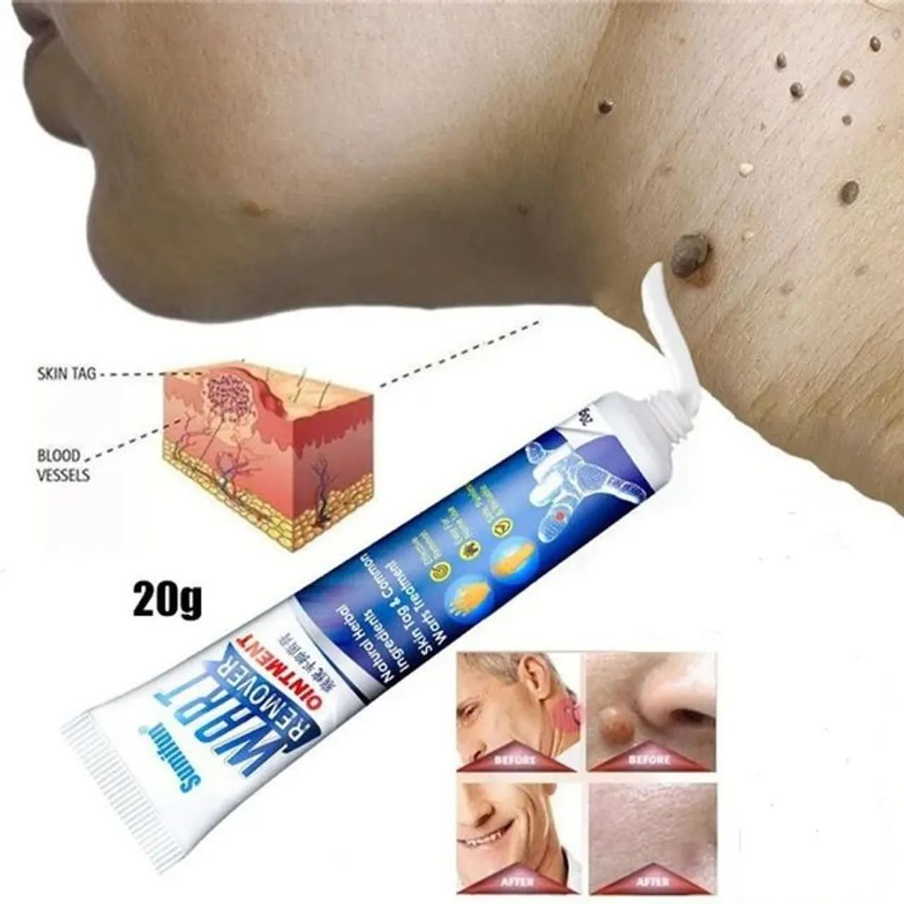 Quick Skin Tag Remover Mole Wart Removal Kit Cleaning Tools Face Skin Care Body Wart Dot Treatments Remover Beauty Health - Sumifun-