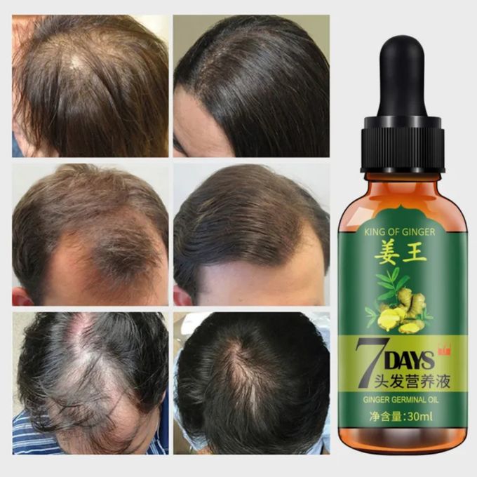 Aichun Beauty King Of Ginger 7 Days Ginger Germinal Oil Hair Growth Care