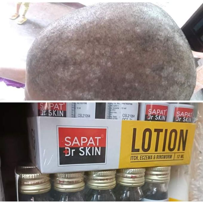 Dr Skin Sapat Lotion With Salicylic Acid For Itch Eczema And Ringworms.