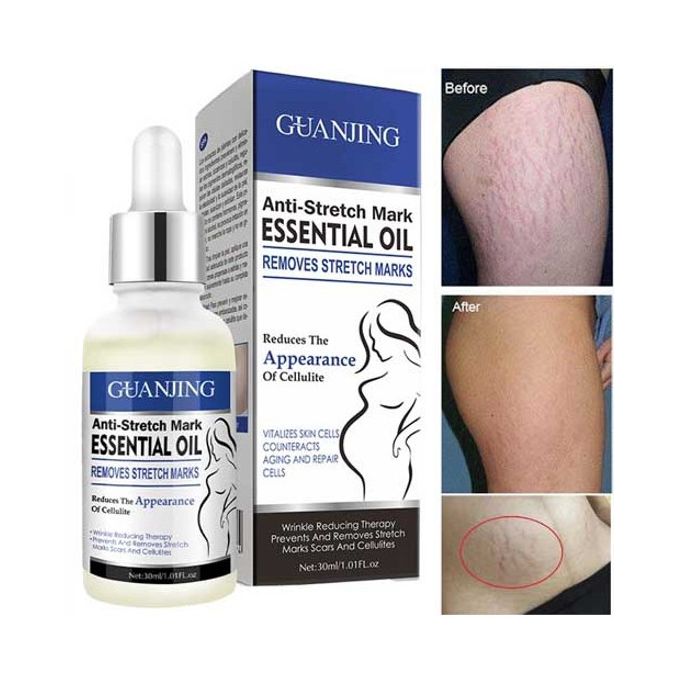 Aichun Anti-Stretch Marks Essential Oil- Stretch Marks Remover & Reduces Cellulite Appearance.