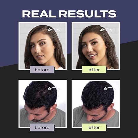 Toppik Hair Building Fibers, 27.5g Fill In Fine or Thinning Hair Instantly Thicker, Fuller Looking Hair for Men & Women