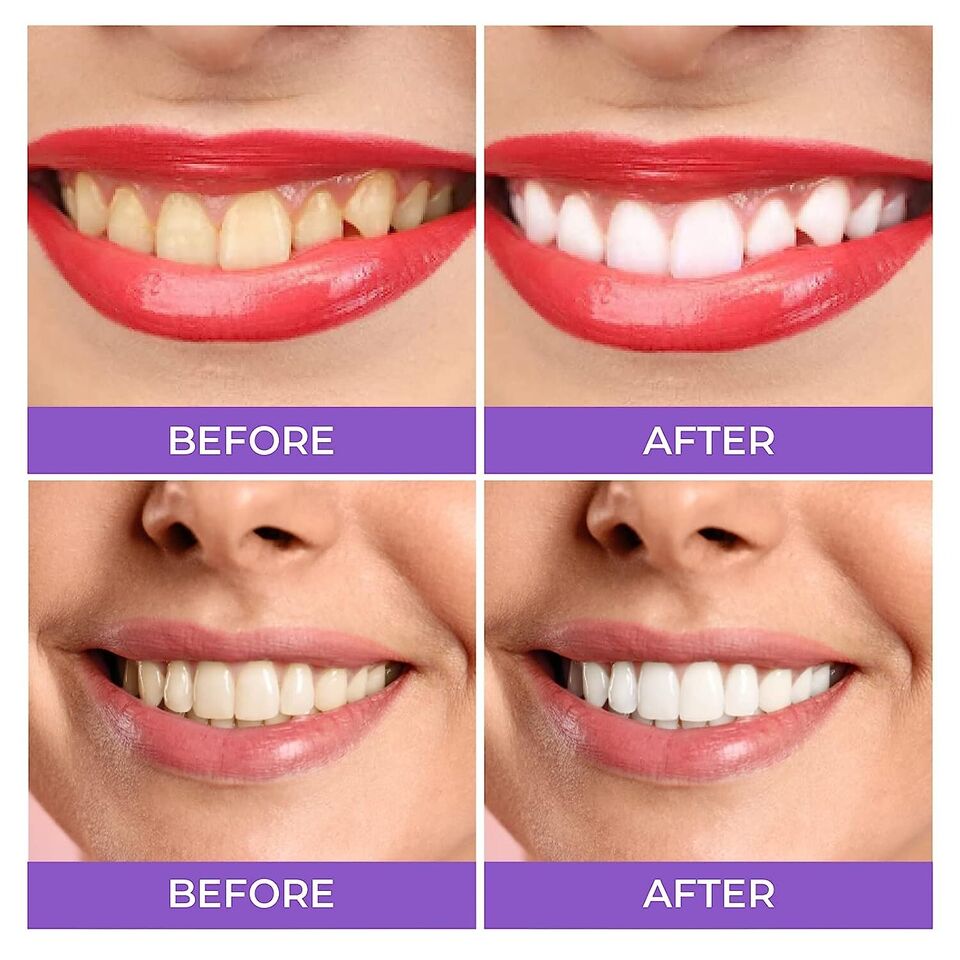 The original Lanthome V34 Purple Teeth Whitening Mousse: Advanced Teeth Whitening, Cigarette Stains Repair ,Neutralizes Yellow Tones removes Dental Plaque ,best Fresh Breath Oral Care