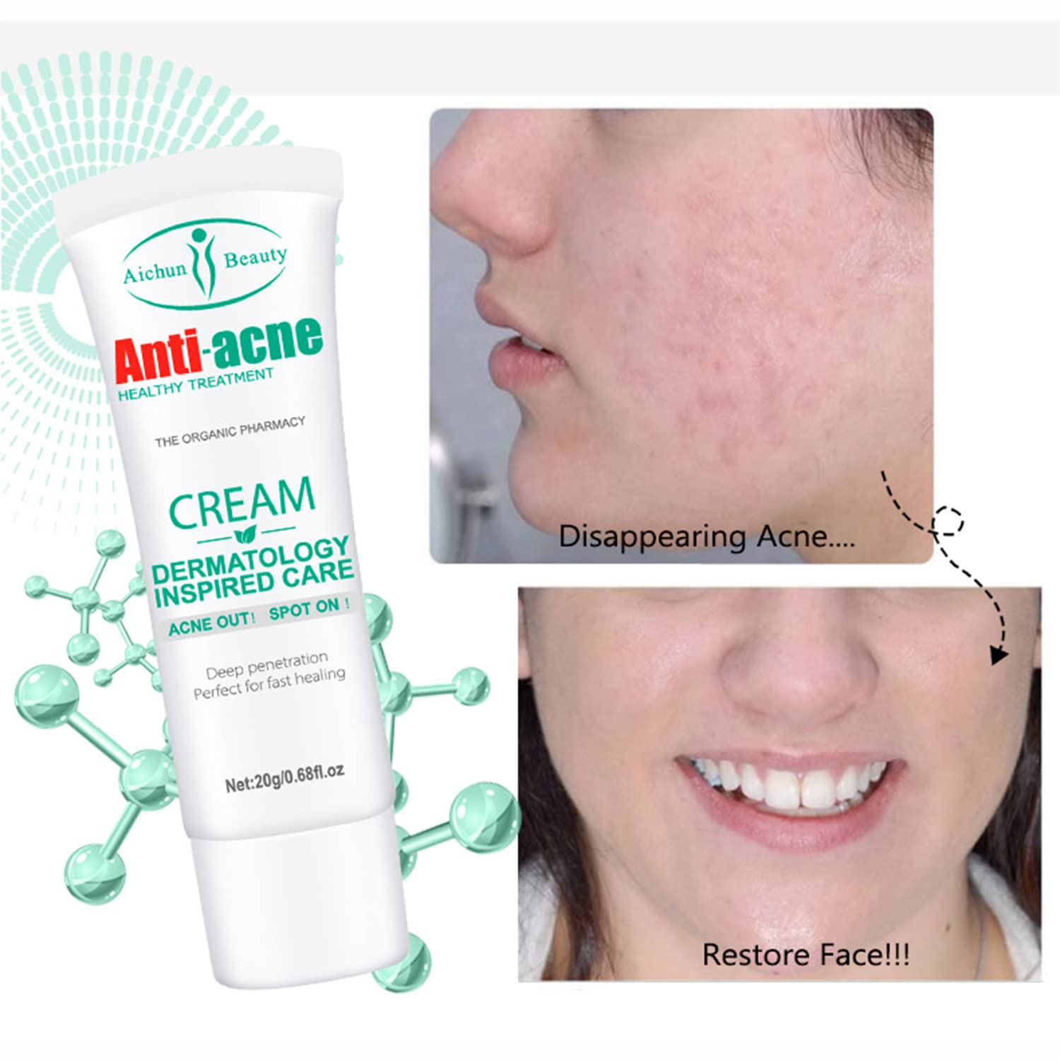 AICHUN BEAUTY Anti-Acne Cream Treats Pimple Clogged Pores Oil Control Reduces Acne Scars Shrinks Pores  0.68fl.oz cne Control Cleansing Oil Control Face Cream & Moisturizer