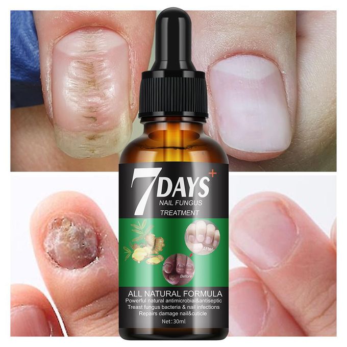 Fungal Nail Treatment Oil Foot Repair Essence Toe Nail Fungus Repair fungus bacteria repair Foot Hands Gel Anti Infection Cream Fungal Nail Removal 30ml- MOOYAM