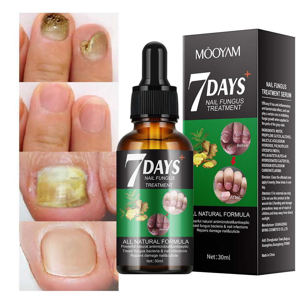 Fungal Nail Treatment Oil Foot Repair Essence Toe Nail Fungus Repair fungus bacteria repair Foot Hands Gel Anti Infection Cream Fungal Nail Removal 30ml- MOOYAM