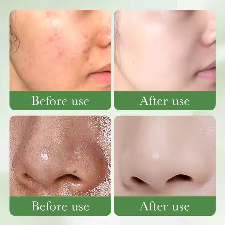 SADOER Salicylic Acid 3% Acne Repair 2-in-1 Skincare Set - Gentle Cleanser with Vitamin C & Repair Serum - Anti-Pimple Treatment, Dark Spot Fading, Pore Tightening & Oil Control Blemish Cleansing Kit