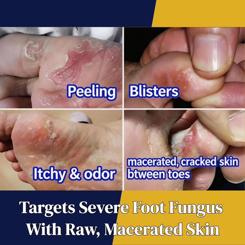 KORMESIC Foot Antifungal Cream – Fast Relief Foot Fungal Infections | Relieves Itching Soothes Peeling Skin & Reduces Redness | OTC Topical Treatment for Toe & Foot Fungus | Effective Daily Foot Care