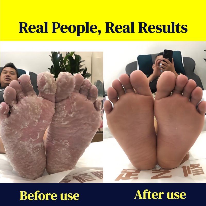 KORMESIC Foot Antifungal Cream – Fast Relief Foot Fungal Infections | Relieves Itching Soothes Peeling Skin & Reduces Redness | OTC Topical Treatment for Toe & Foot Fungus | Effective Daily Foot Care