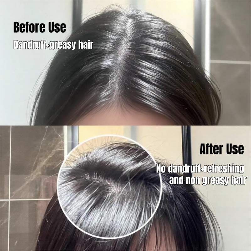 Selenium Sulfide Super Anti-Dandruff Shampoo - Dandruff Killer & Oil Control Scalp Cleanser Hair Care- Medicated Formula for Severe Dandruff & Oily Scalp Leave Hair Fresh Strong Anti-Dandruff Shampoo