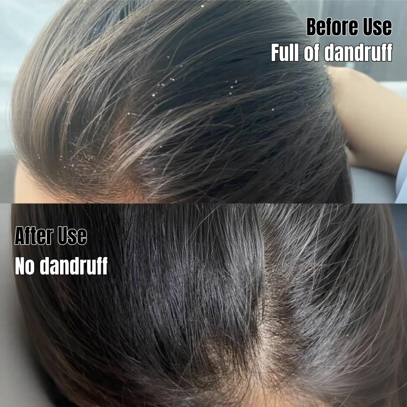 Selenium Sulfide Super Anti-Dandruff Shampoo - Dandruff Killer & Oil Control Scalp Cleanser Hair Care- Medicated Formula for Severe Dandruff & Oily Scalp Leave Hair Fresh Strong Anti-Dandruff Shampoo