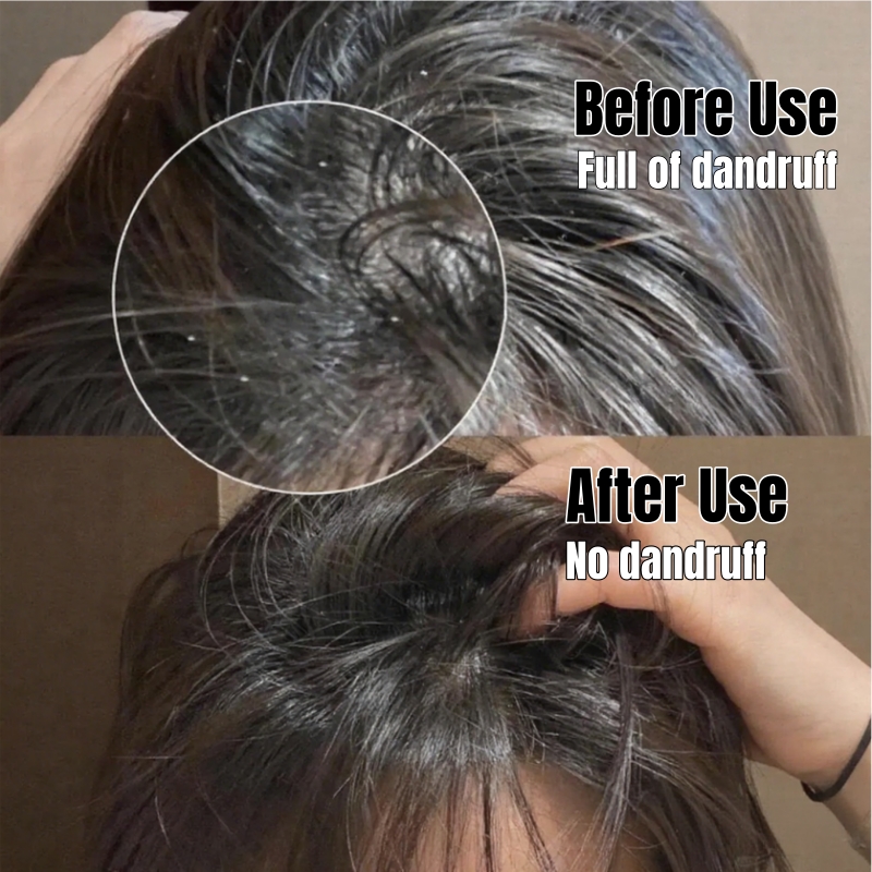 Selenium Sulfide Super Anti-Dandruff Shampoo - Dandruff Killer & Oil Control Scalp Cleanser Hair Care- Medicated Formula for Severe Dandruff & Oily Scalp Leave Hair Fresh Strong Anti-Dandruff Shampoo