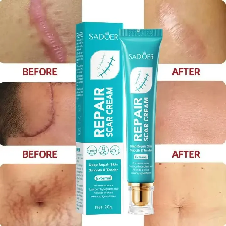 SADOER Scar Repair Cream Scar Moisturizing Tender Light Line Scar Removal Cream Repair Stretch Marks Burn Acne Surgical Acne Scar Ointment Herbal Treatment Gel