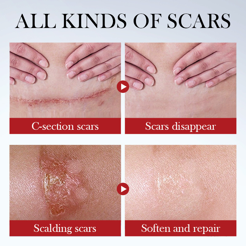 SADOER Scar Repair Cream Scar Moisturizing Tender Light Line Scar Removal Cream Repair Stretch Marks Burn Acne Surgical Acne Scar Ointment Herbal Treatment Gel