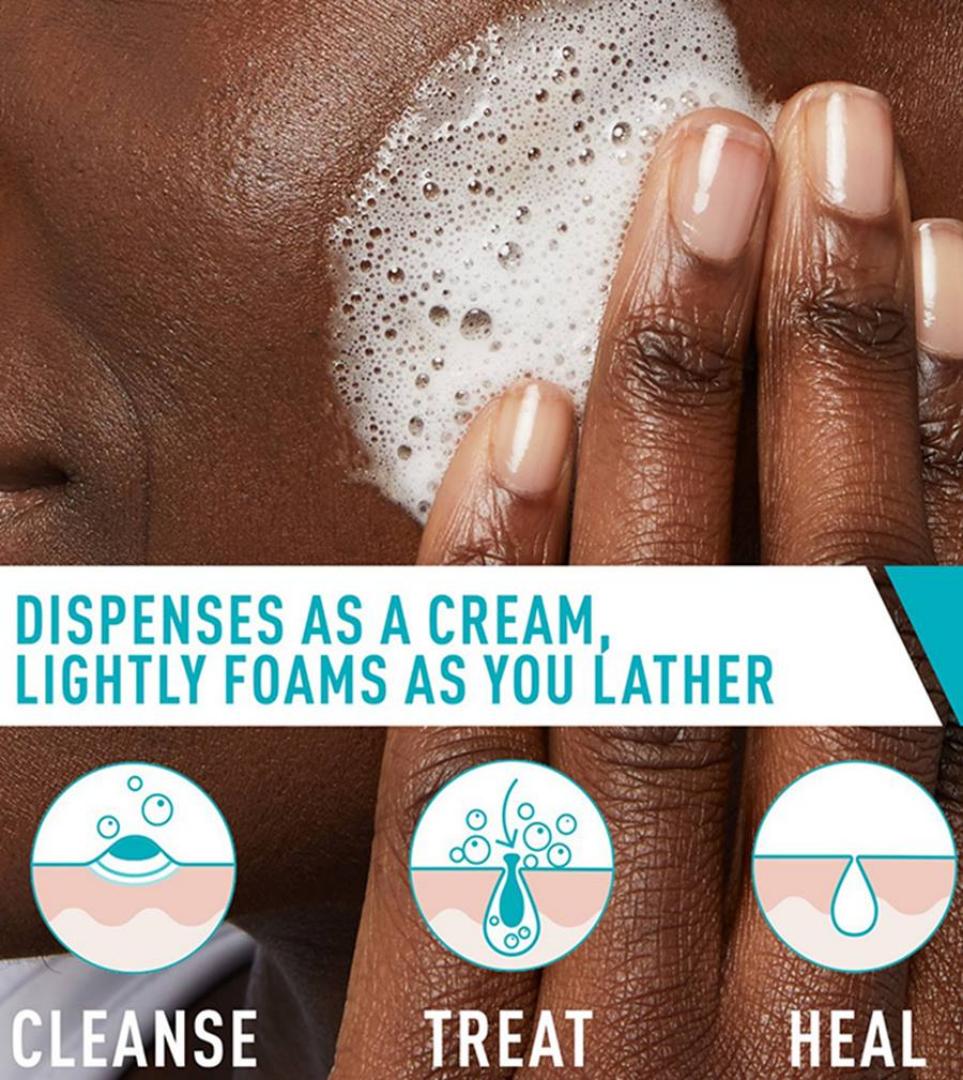 CeraVe Acne Foaming Cream Cleanser contains 4% benzoyl peroxide to treat acne pimples and blackheads.