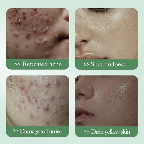 SADOER Salicylic Acid Cream Acne Repair Face Cream - Healing Cream, Deep Cleansing Formula for Clear Skin, Oil Balance & Blemish Repair 50g
