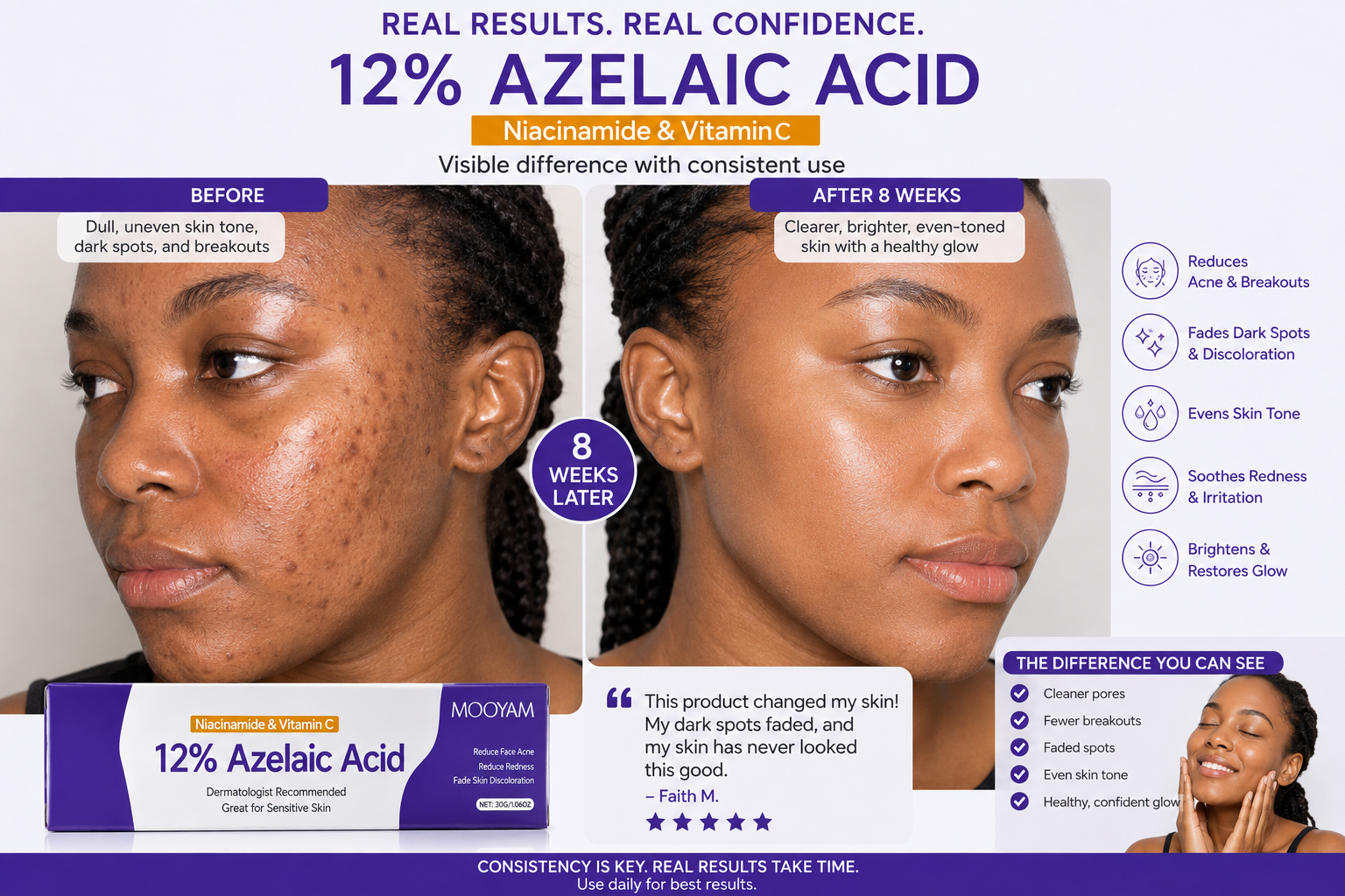 MOOYAM 12% Azelaic Acid Face Cream with Niacinamide and Vitamin C for Acne Dark Spots Hyperpigmentation Acne Marks Redness Blemishes Uneven Skin Tone Pore Care Sensitive Skin 20g