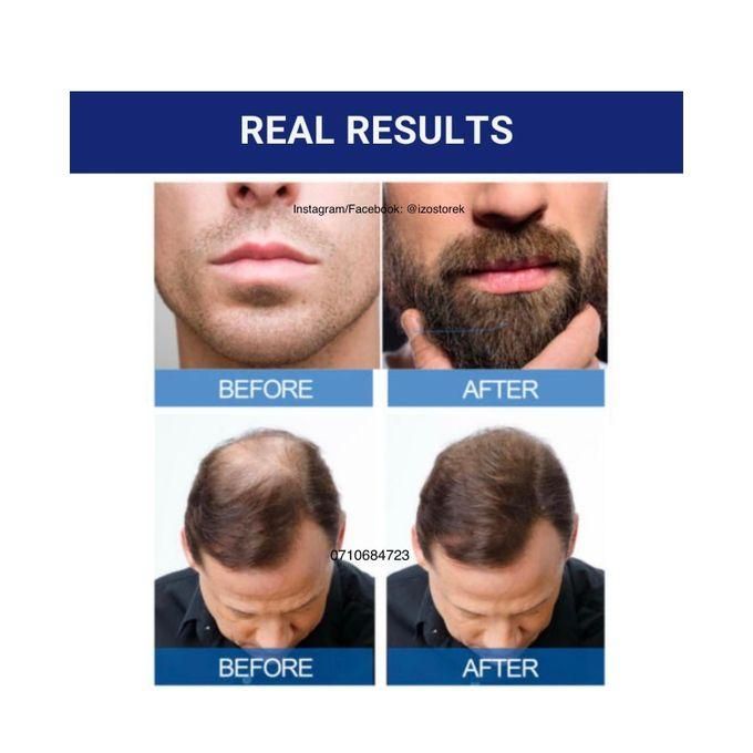 Kirkland Minoxidil 5% extra strength hair loss regrowth system treatment for men Beard care oil premium Topical Solution Growth Nourishing Serum 6 bottle of 60ml (6 months supply)
