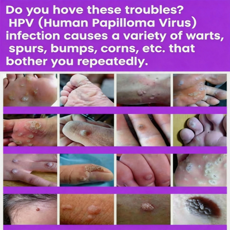 Wart Removal Cream, Ancient Chinese Medical Recipes,removal warts caused by HPV (Human Papilloma Virus) /filiform warts/flat warts/common warts/genital warts/corns/granules/spurs/skin bumps