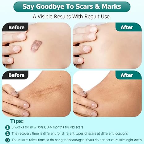 Scar Cream Silicone Scar Gel Medical Grade Scar Gel Facial Care Gel Pigmentation Corrector for Surgical skin Scars Hypertrophic Keloid C-Section Burn Old and New Scars Professional Scar Removal Gel