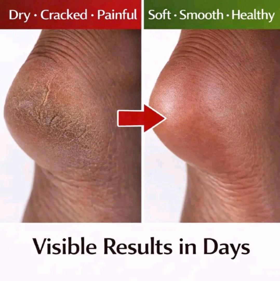 ​[ORIGINAL] Cindynal Horse Oil Cracked Heel Repair Cream (100g) – Deep Moisture with Urea & Shea Butter for Soft, Smooth Feet.