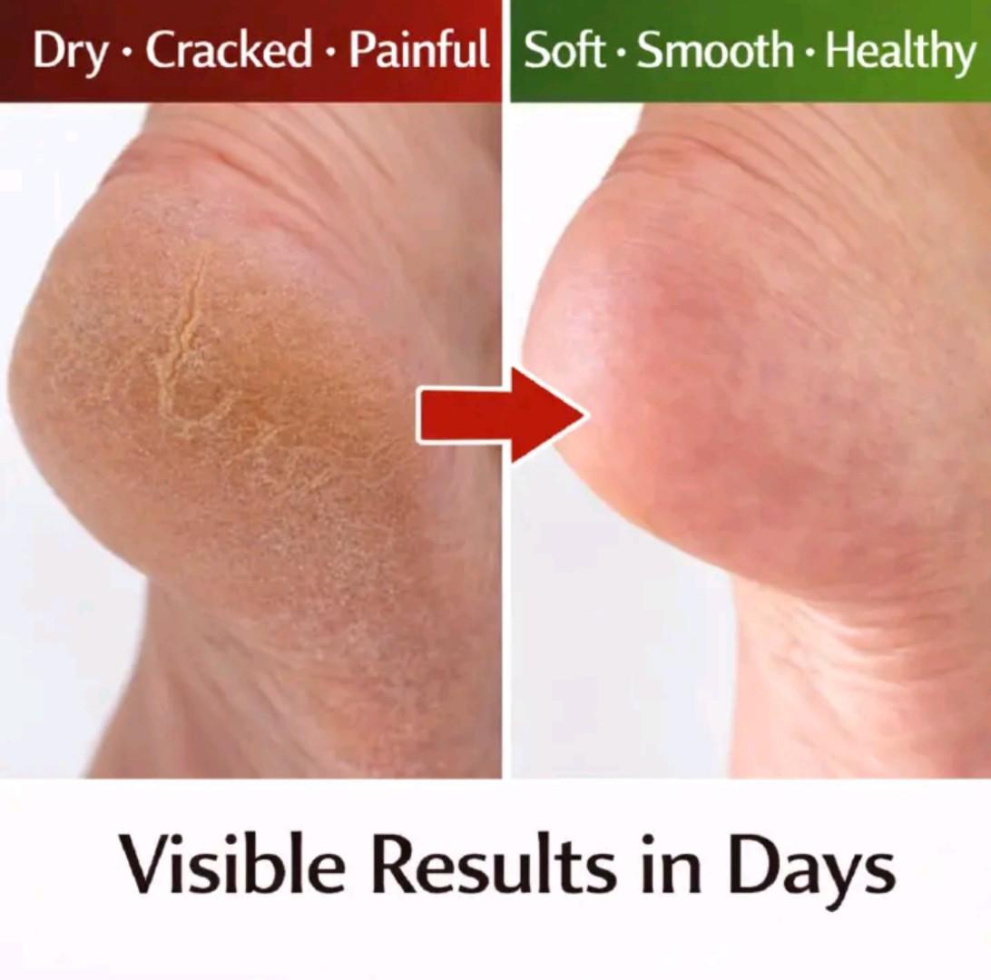 ​[ORIGINAL] Cindynal Horse Oil Cracked Heel Repair Cream (100g) – Deep Moisture with Urea & Shea Butter for Soft, Smooth Feet.
