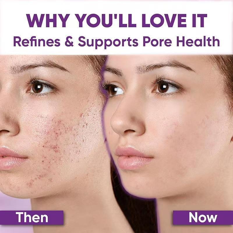 15% Azelaic Acid Blemish Removal Cream, 15% Azelaic Acid Facial Cream 20g, Niacinamide Vitamin C, Reduce Acne & Dark Spots, Skin Redness Relief