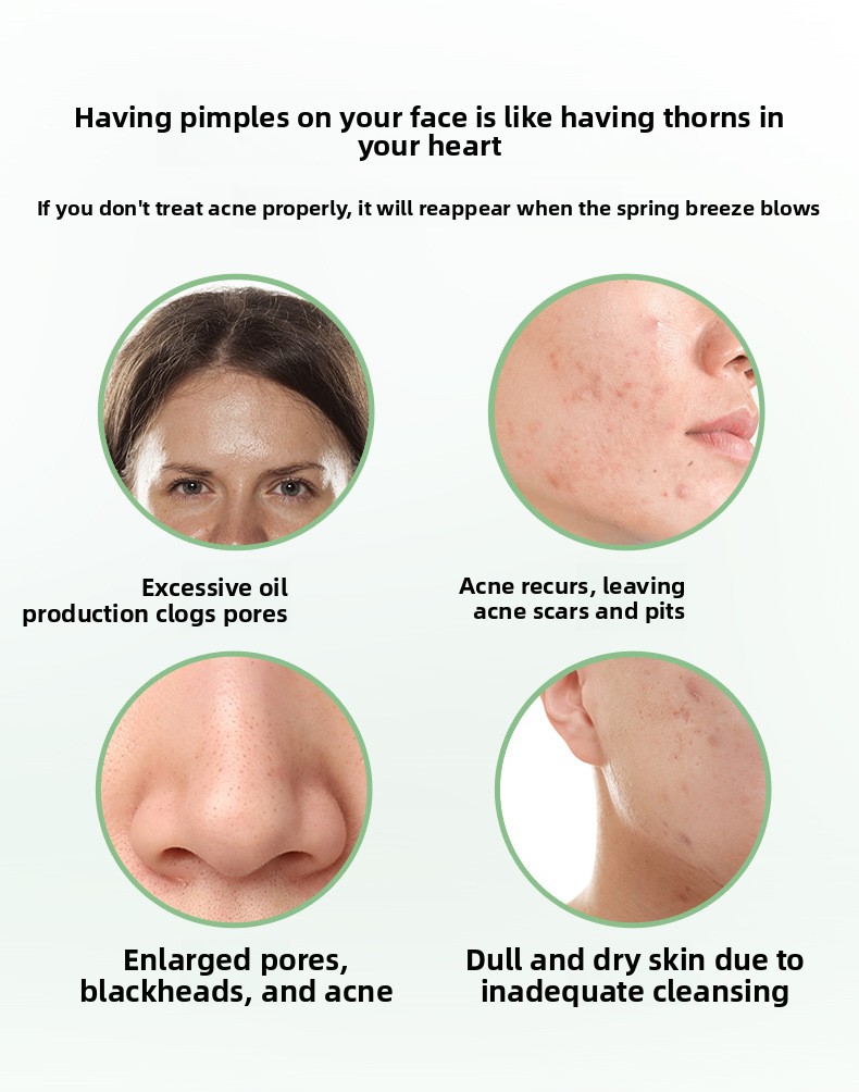 Salicylic Acid Acne Removal Cream, Pimple & Blackhead Spot Treatment, Fade Acne Marks, Oil Control & Gentle Skin Repair for Face