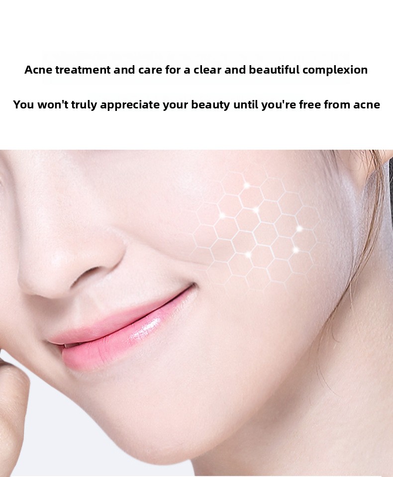 Salicylic Acid Acne Removal Cream, Pimple & Blackhead Spot Treatment, Fade Acne Marks, Oil Control & Gentle Skin Repair for Face
