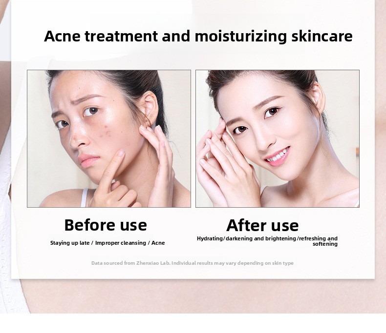 Salicylic Acid Acne Removal Cream, Pimple & Blackhead Spot Treatment, Fade Acne Marks, Oil Control & Gentle Skin Repair for Face