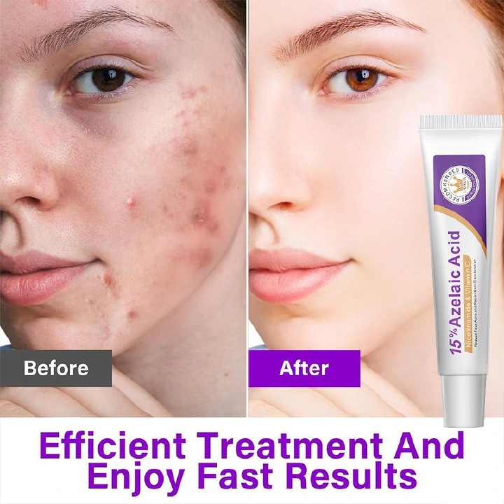 15% Azelaic Acid Blemish Removal Cream, 15% Azelaic Acid Facial Cream 20g, Niacinamide Vitamin C, Reduce Acne & Dark Spots, Skin Redness Relief
