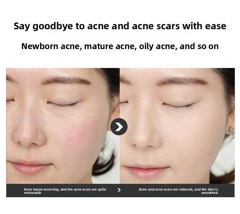 Salicylic Acid Acne Removal Cream, Pimple & Blackhead Spot Treatment, Fade Acne Marks, Oil Control & Gentle Skin Repair for Face