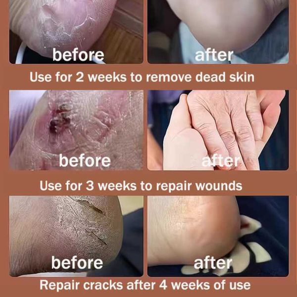 85g Anti Crack Foot Cream Dryness Foot Mask Heel Cracked Repair Cream Hand Mositurizing Removal Callus Dead Skin Hands Feet Care Anti freezing and Anti cracking Foot Cream 85g Hand Cream Moisturizing.