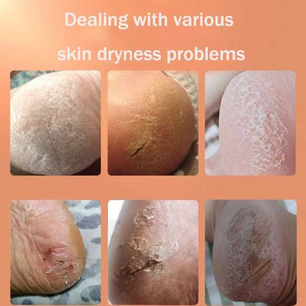85g Anti Crack Foot Cream Dryness Foot Mask Heel Cracked Repair Cream Hand Mositurizing Removal Callus Dead Skin Hands Feet Care Anti freezing and Anti cracking Foot Cream 85g Hand Cream Moisturizing.