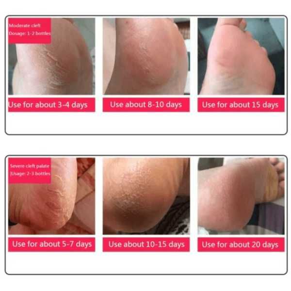 85g Anti Crack Foot Cream Dryness Foot Mask Heel Cracked Repair Cream Hand Mositurizing Removal Callus Dead Skin Hands Feet Care Anti freezing and Anti cracking Foot Cream 85g Hand Cream Moisturizing.
