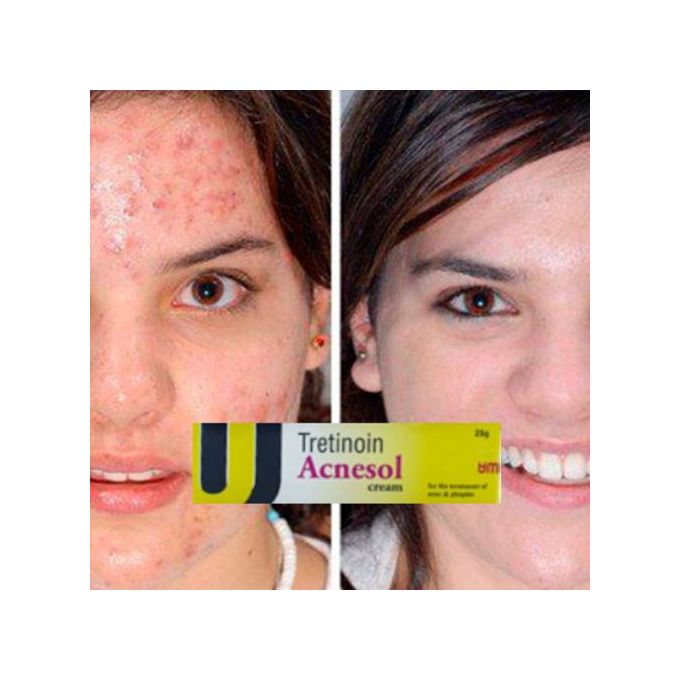 Acnesol tretinoin Cream 25g - Powerful Acne Treatment For Clearer, Smoother SkinSkin damage
Fade Acne Scars,Brighten,Glow,Boost Your Skin Beauty Regimen,Better skin products absorption.
