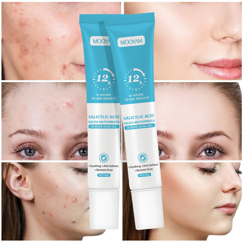 Salicylic Acid Acne Cream 12H Fast Result For Face, Remove Acne Pimple Blackhead Closed Comedones, Fade Acne Scars Dark Marks, Anti Redness Soothing Oil Control Pore Minimizer, For Women Men Teens