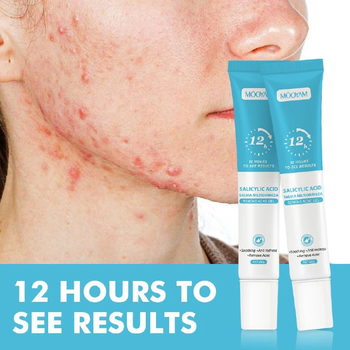 Salicylic Acid Acne Cream 12H Fast Result For Face, Remove Acne Pimple Blackhead Closed Comedones, Fade Acne Scars Dark Marks, Anti Redness Soothing Oil Control Pore Minimizer, For Women Men Teens