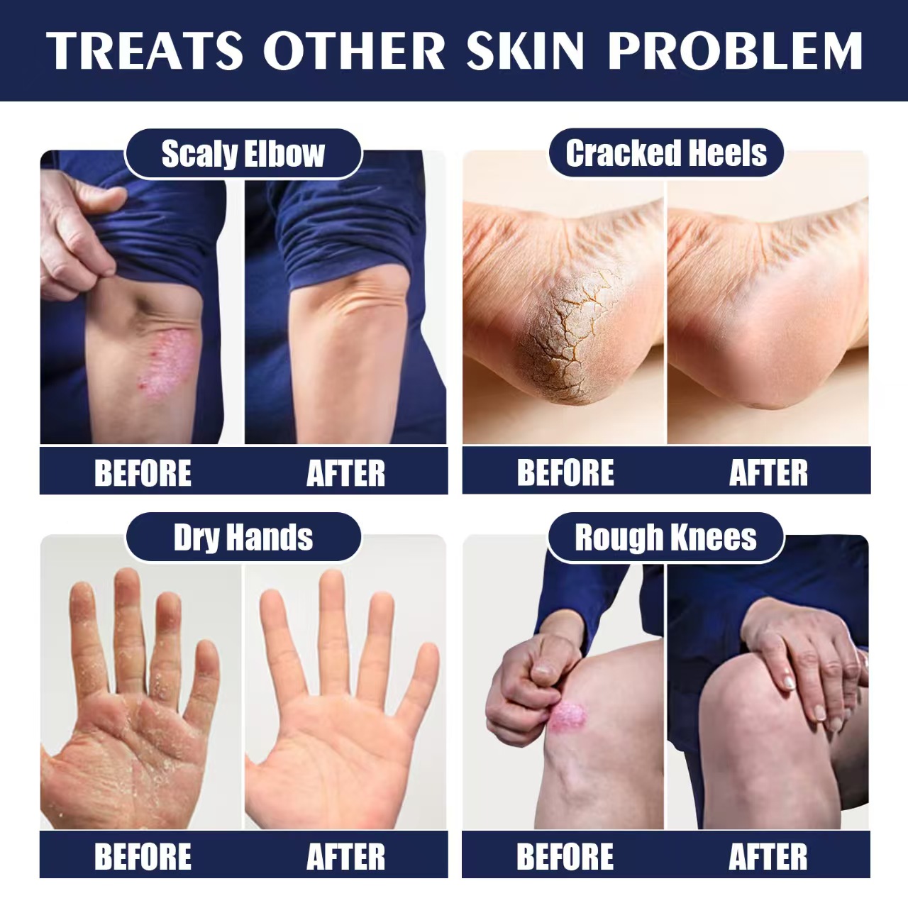 50 PCS Cracked Tape +88g Anti Crack Foot Cream Dryness Foot care set Foot Mask Heel Cracked Repair Cream  feet treatment cracked heel repair kit