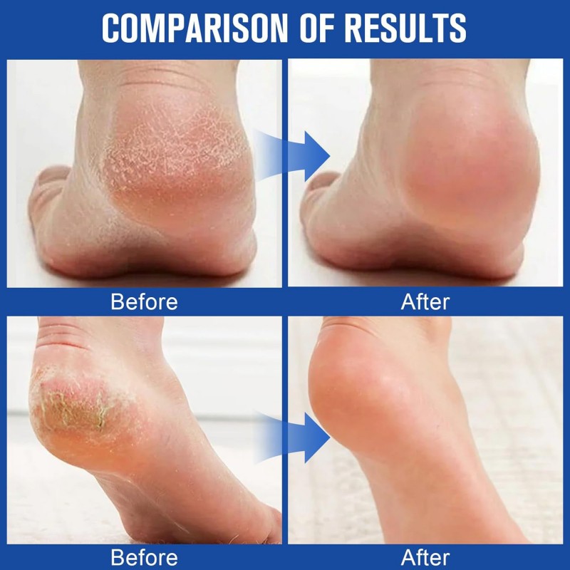Deep Repair Long-Lasting Moisturizing Gentle Exfoliating Women's Urea Cream Stick 2% Salicylic Acid