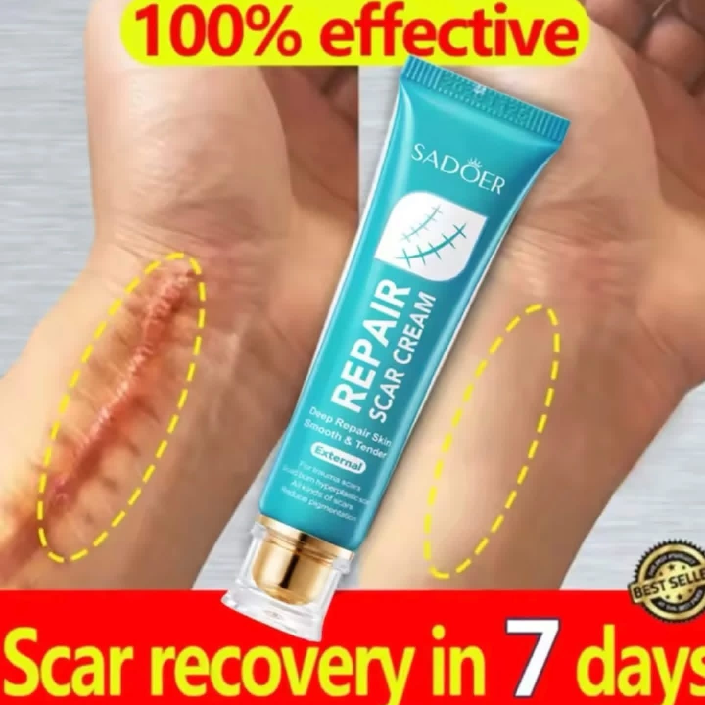 Scar removal Cream Gel，Advance Scar Gel，Advanced Formula Scar Gel for Old & New Scars, Acene, C-Section, Stretch Marks, Old and New Scars ,Keloids Scar Removal Cream - SADOER -