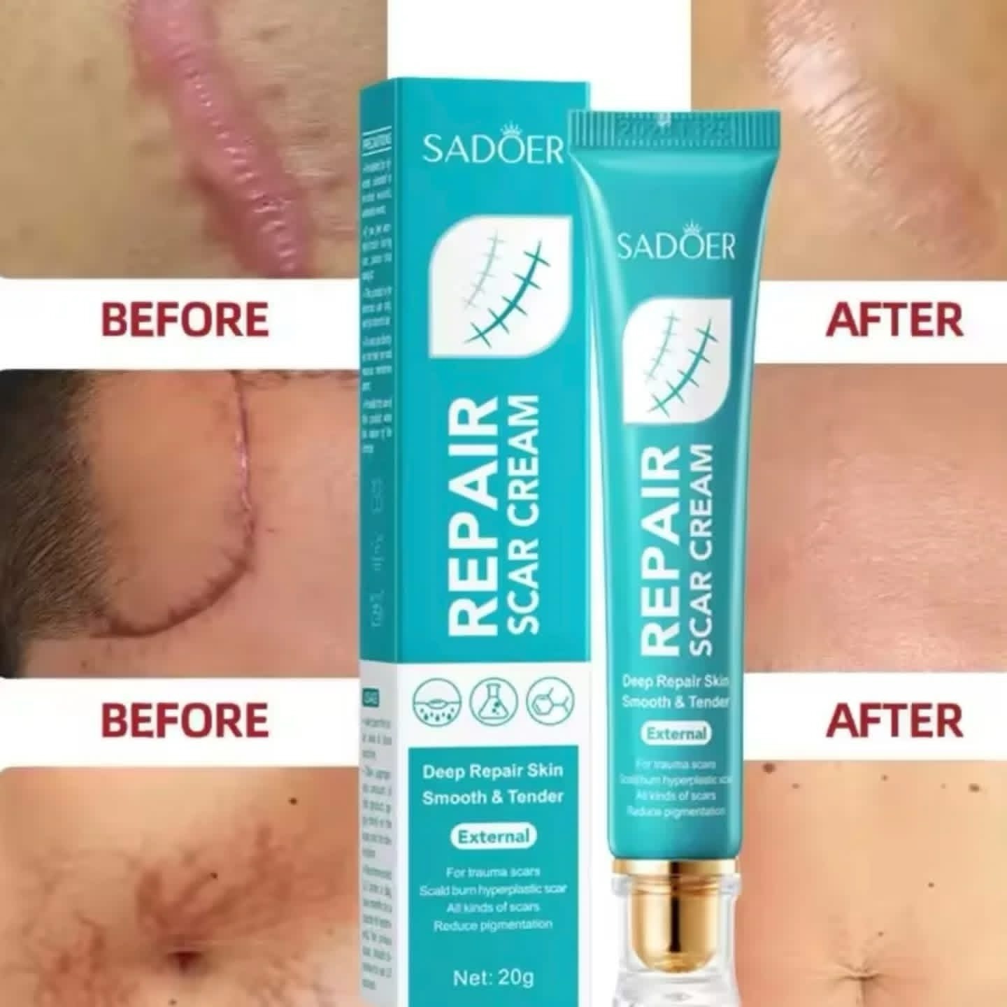 Scar removal Cream Gel，Advance Scar Gel，Advanced Formula Scar Gel for Old & New Scars, Acene, C-Section, Stretch Marks, Old and New Scars ,Keloids Scar Removal Cream - SADOER -
