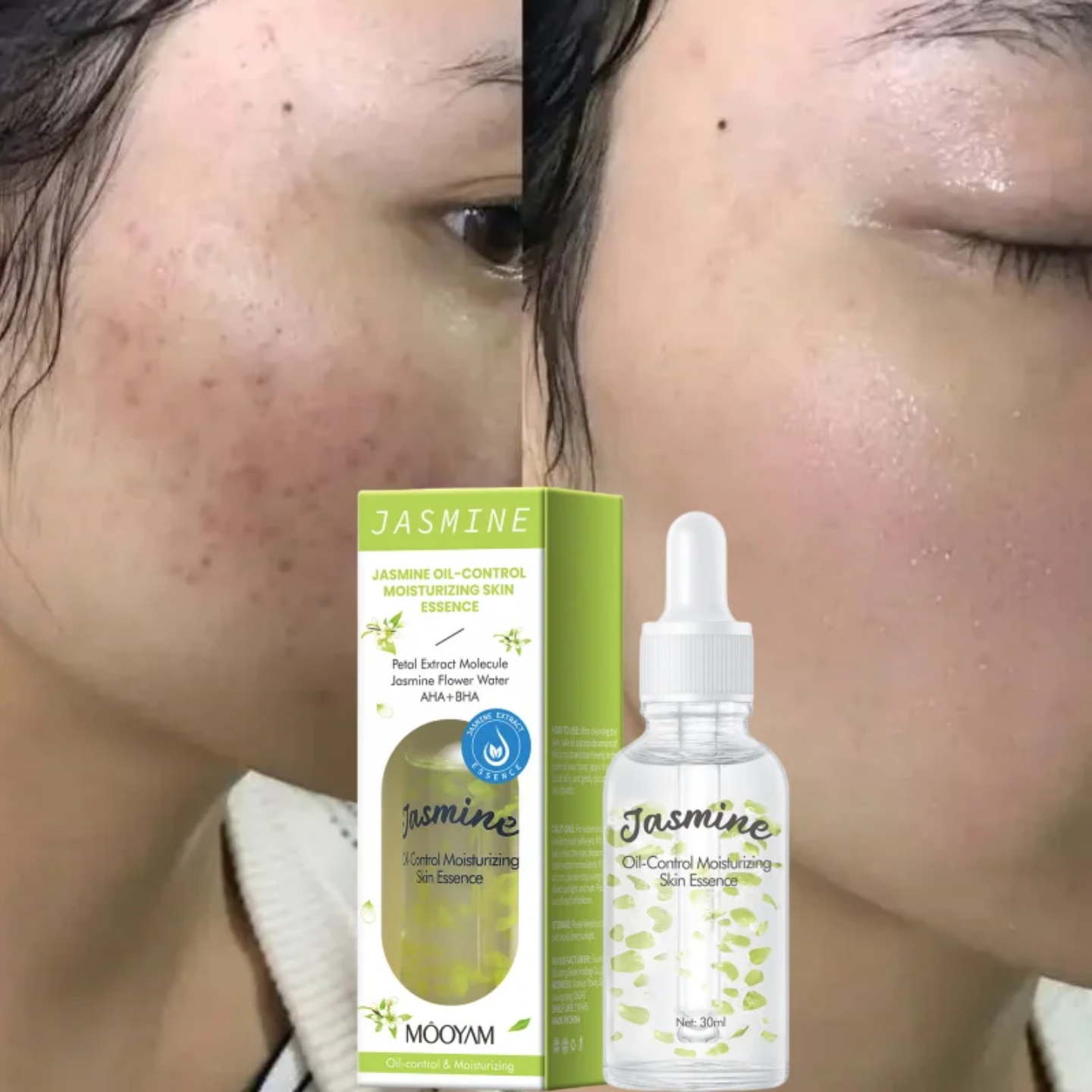 JASMINE OIL-CONTROL MOISTURIZING SKIN ESSENCE 30ML - AHA + BHA DARK SPOT REMOVER, ACNE TREATMENT & PORE TIGHTENING FACIAL SERUM FOR OILY SKIN