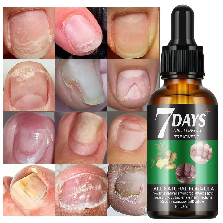 Fungal Nail Treatment Oil Foot Repair Essence Toe Nail Fungus Repair fungus bacteria repair Foot Hands Gel Anti Infection Cream Fungal Nail Removal 30ml- MOOYAM
