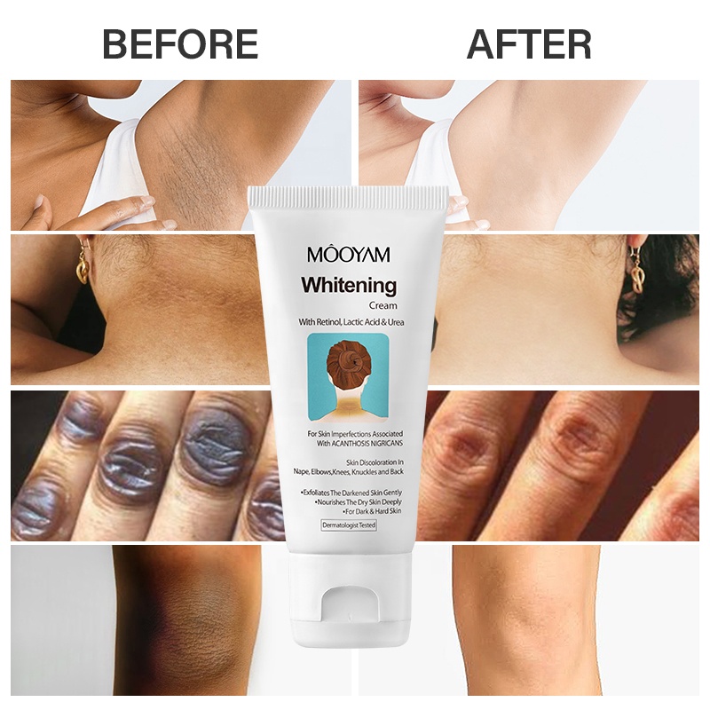 MOOYAM Whitening Cream with Retinol, Lactic Acid, Urea Acanthosis Nigricans Remove Black Patches Dark Spot Corrector Knee Elbow Underarm Knuckles Neck Lightening Skin Cream