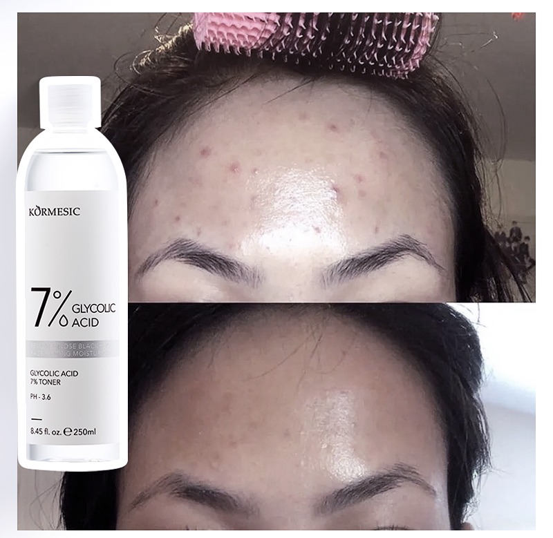 Glycolic Acid Toner 7%, Exfoliate, Reduce Blemishes, Rejuvenate Skin, Pore Reducing Toner Glycolic Acid -Exfoliating Toner to Brighten Skin, Reduce Dark Spots Radiant Complexion Enhancer - KORMESIC