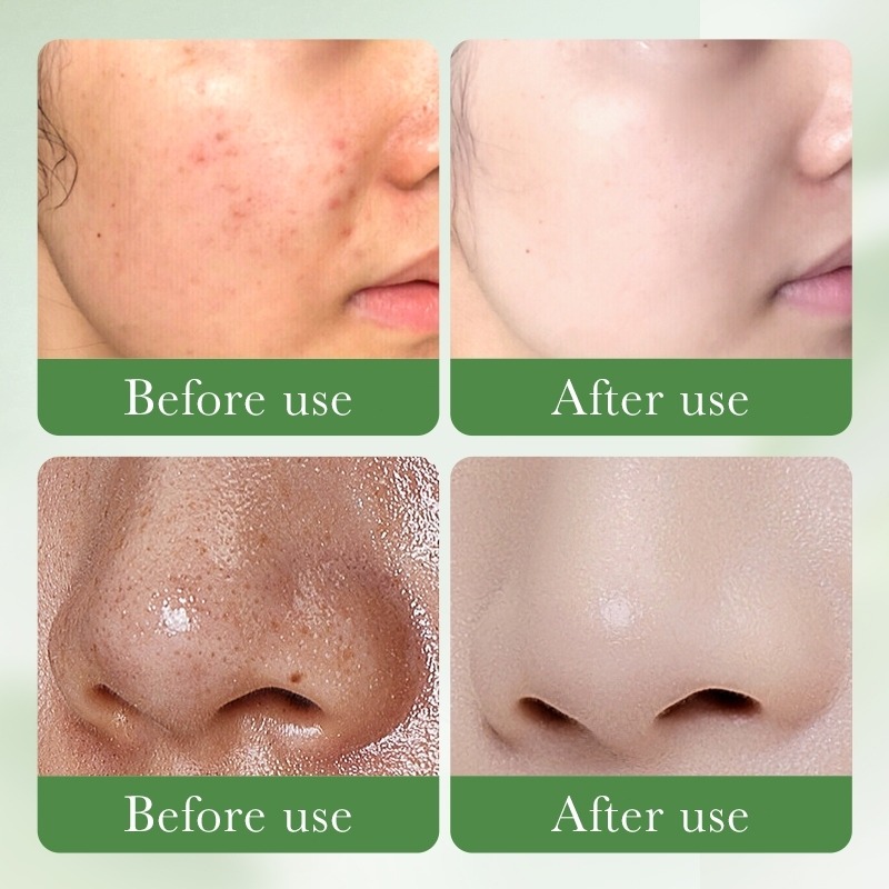 Salicylic Acid 3% Cleanser Acne Remover Face Cleanser Oil Control, Pore Deep Cleansing Foam, Hydrating Daily Facial Cleanser -Acne Treatment Cleanser Deep Cleaning Face Wash-Gentle Foaming -