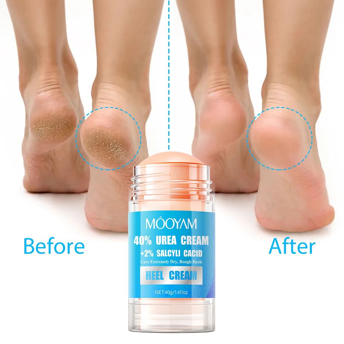 Urea 60% Cream Stick for Moisturizing, Repairing, Exfoliating, and Nourishing Cracked Skin on Hands & Feet